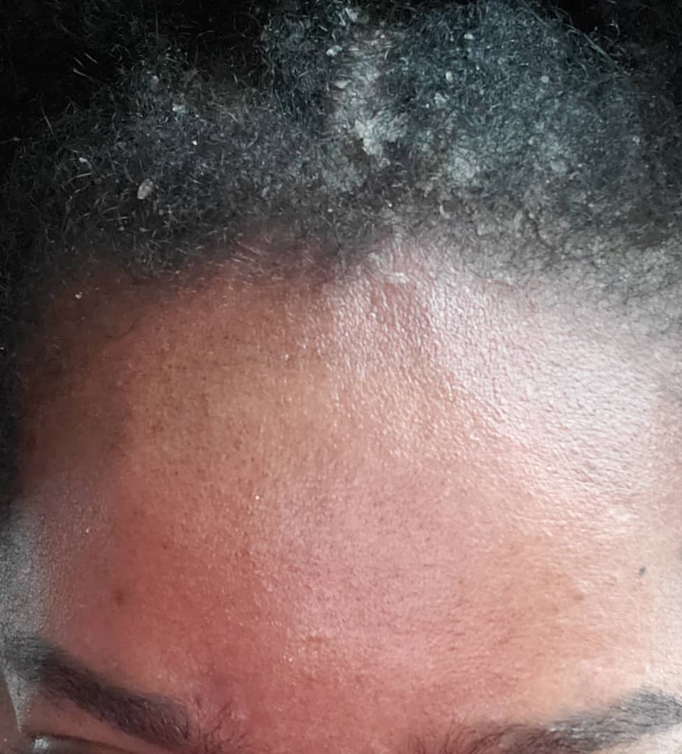 Anti-Dandruff and Hydrate Set of 6 UNISEX